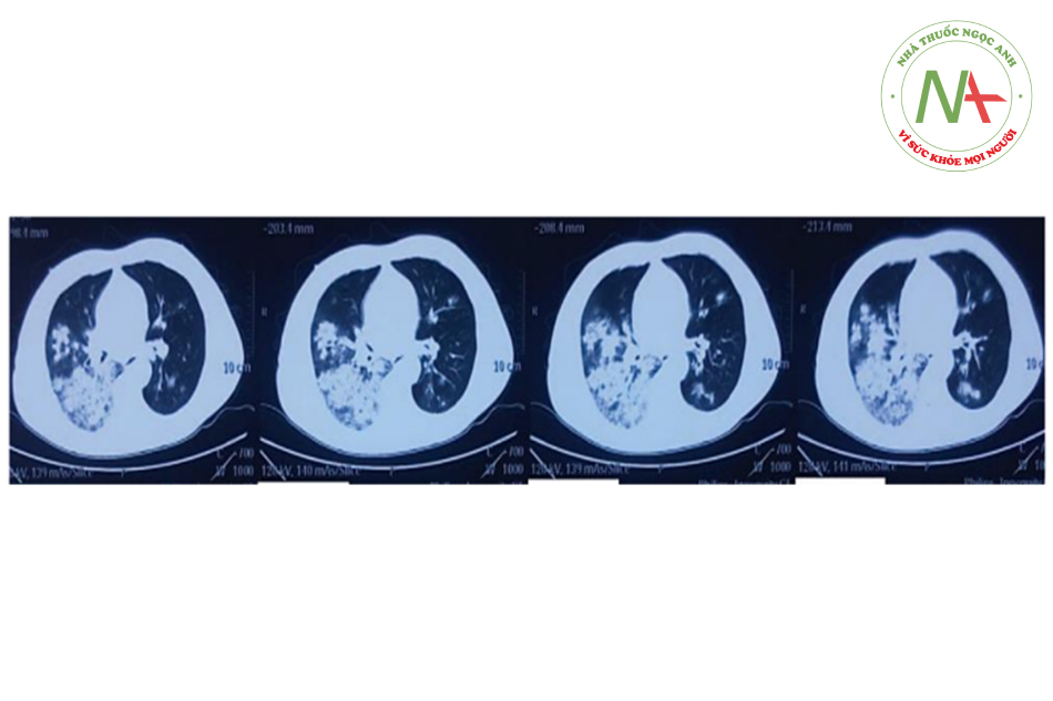Hình CT các slide cắt qua tim chụp trước khi vào cấp cứu