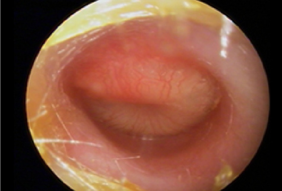 Hình 1: Biểu hiện khi soi tai là màng nhĩ có ban đỏ, phồng căng Từ tư liệu cá nhân của BS. Armengol