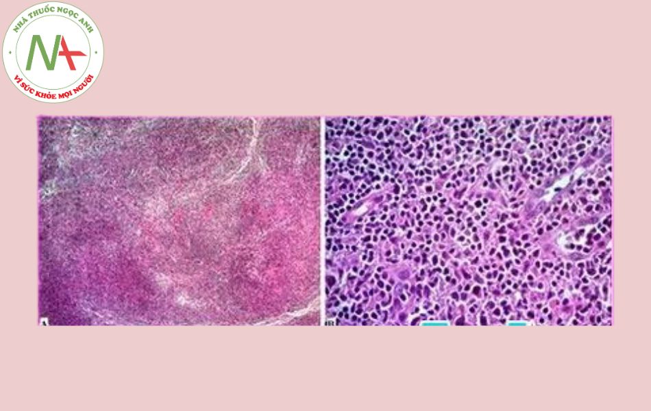 Nhân một trường hợp u lympho B vùng rìa tại hạch có sự tái sắp xếp gen Ig và TCR