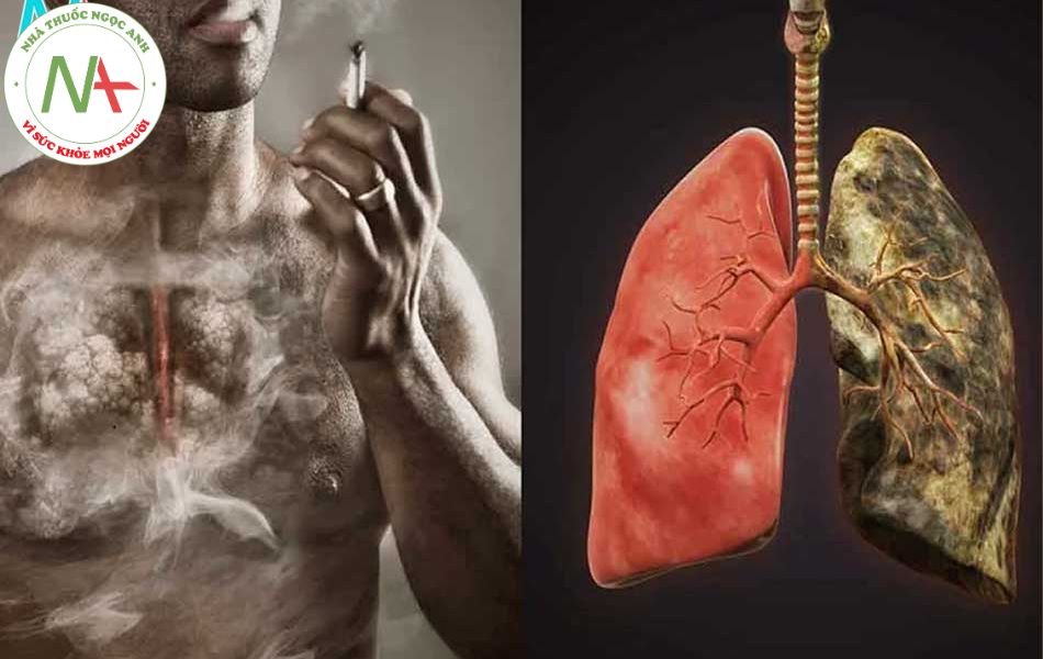Hút thuốc là nguyên nhân chính dẫn đến ung thư phổi