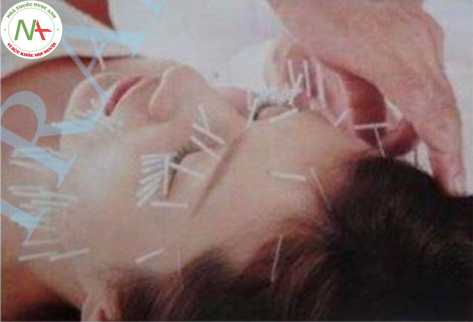 Fig 8. Aesthetic acupuncture