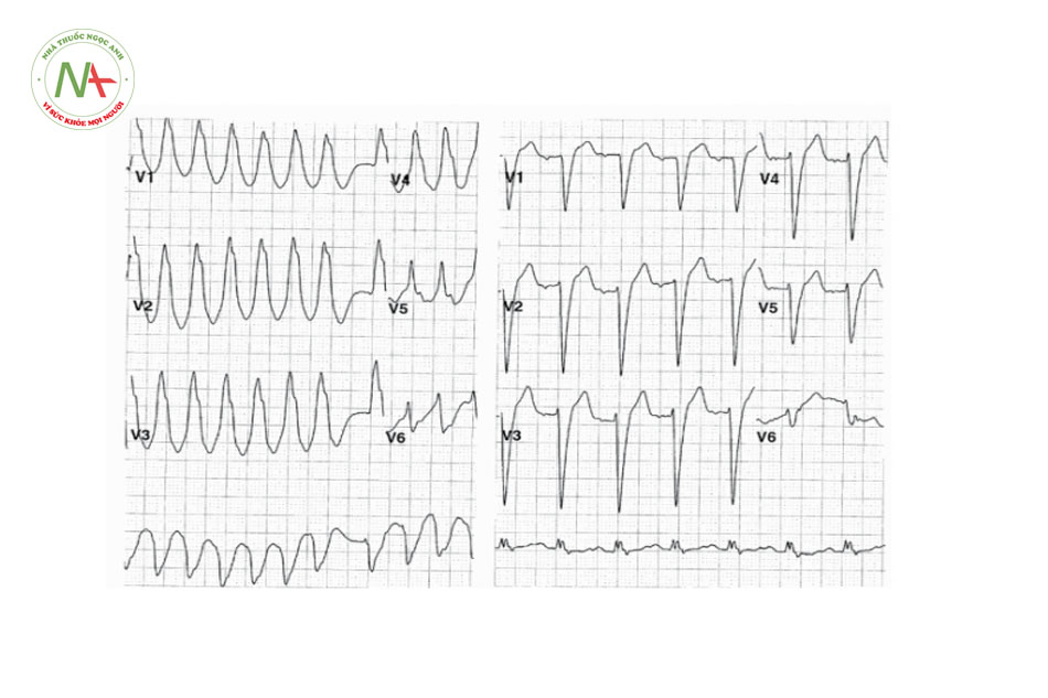 Hình 18. Cơn tim nhanh thất. Hình bên trái: Cơn tim nhanh thất với QRS giãn rộng và đơn dạng, tại chuyển đạo V1 có dạng block nhánh phải, tần số phức bộ QRS không đều nhau. Hình bên phải: tại thời điểm nhịp xoang, phức bộ QRS có dạng block nhánh trái.