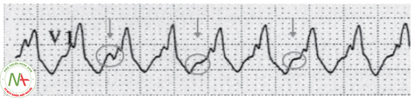 Hình 19. Phân ly nhĩ thất. Phức bộ QRS giãn rộng đi xen kẽ sóng P xoang (mũi tên) thể hiện trên điện tâm đồ như những dạng “móc” hay “khía” rơi vào phía trước hoặc sau phức bộ QRS.