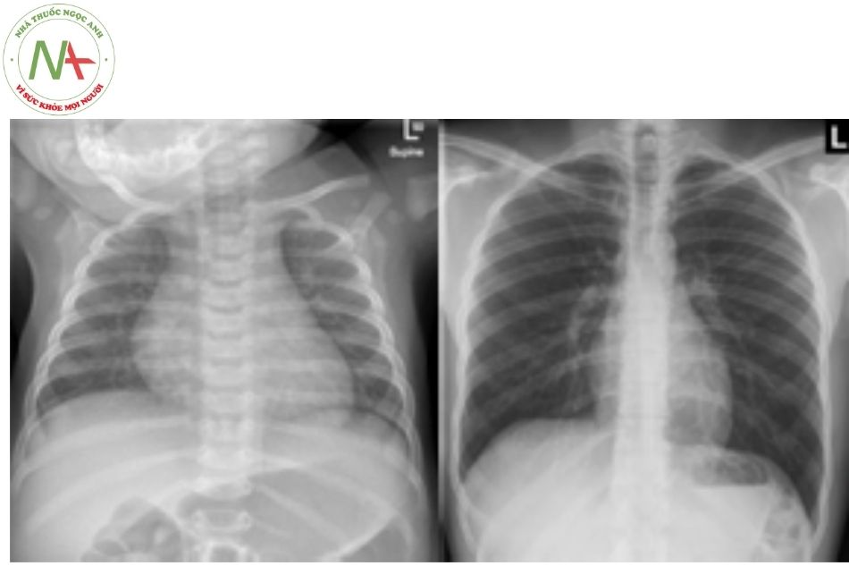 Hình 2. Hình ảnh Xquang tim phổi thẳng (Hình bên trái: Trẻ em; Hình bên phải: Người lớn) /> Hình 2. Hình ảnh Xquang tim phổi thẳng (Hình bên trái: Trẻ em; Hình bên phải: Người lớn)</p> <h3>Vị trí của tim</h3> <p>Trong trung thất mỏm tim thường hướng sang trái, ra trước và xuống dưới. Tư thế tim như vậy gọi là <strong>tư thế tim bình thường </strong>(levocardia). Ngược với tư thế bình thường là <strong>tư thế tim quay phải </strong>(dextrocardia).</p> <p>Ở trẻ sơ sinh trục mỏm tim có xu hướng đi ngang hơn so với trẻ lớn và người trưởng thành.</p> <h2>Màng ngoài tim</h2> <p>Màng ngoài tim bao phủ tim gồm hai lớp: <strong>lá tạng màng ngoài tim </strong>hay thượng tâm mạc phủ trên bề mặt quả tim và một lớp phủ bên ngoài gọi là <strong>lá thành màng ngoài tim</strong>. Giữa hai lớp màng ngoài tim là khoang màng ngoài tim chứa thanh dịch (≤ 25 ml ở người trưởng thành) có vai trò bôi trơn, giúp quả tim co bóp, cử động một cách trơn tru trong lồng ngực. Lá thành màng ngoài tim còn có vai trò hạn chế kích thước cuối tâm trương của tim.</p> <h3>Lá thành màng tim</h3> <p>Lá thành màng ngoài tim như một cái túi dày, có dạng chiếc bình cổ hẹp bao quanh tim và bám tận ở các mạch máu lớn. Như vậy, động mạch chủ lên, thân động mạch phổi, 2-4 cm đoạn đầu của tĩnh mạch chủ trên và một đoạn ngắn hơn của tĩnh mạch phổi và tĩnh mạch chủ dưới nằm trong khoang màng ngoài tim.</p> <p>Bệnh nhân có tĩnh mạch phổi đổ lạc chỗ hoàn toàn, hội lưu tĩnh mạch phổi nằm trong khoang màng ngoài tim, ở phía sau tim.</p> <p>Động mạch phổi phải, trái và ống động mạch là các cấu trúc nằm phía ngoài khoang màng ngoài tim do đó những phẫu thuật khu trú tại các cấu trúc này không cần thiết phải mở màng tim.</p> <p>Lá thành màng ngoài tim bao gồm lớp ngoài là lớp xơ và lớp trong là lớp thanh mạc của các tế bào trung mô. Lớp xơ mặt ngoài chứa nhiều sợi collagen, có độ dày < 1 mm ở người trưởng thành. Bề mặt ngoài lá thành còn có các mô mỡ bám đặc biệt ở vị trí trên cơ hoành tạo nên bờ bóng tim trên phim chụp Xquang thông thường. Lá thành màng ngoài tim chứa rất ít sợi chun nên không có khả năng căng giãn đột ngột.</p> <p>Trên lâm sàng, sự xuất hiện nhanh một thể tích khoảng 200 ml dịch trong khoang màng ngoài tim có thể gây ra tình trạng ép tim huyết động. Trái lại nếu sự xuất hiện dịch tăng lên từ từ mạn tính, khoang màng ngoài tim có thể giãn thích nghi và chứa tới 1 lít dịch mới gây nên những biến đổi huyết động.</p> <p><img class=