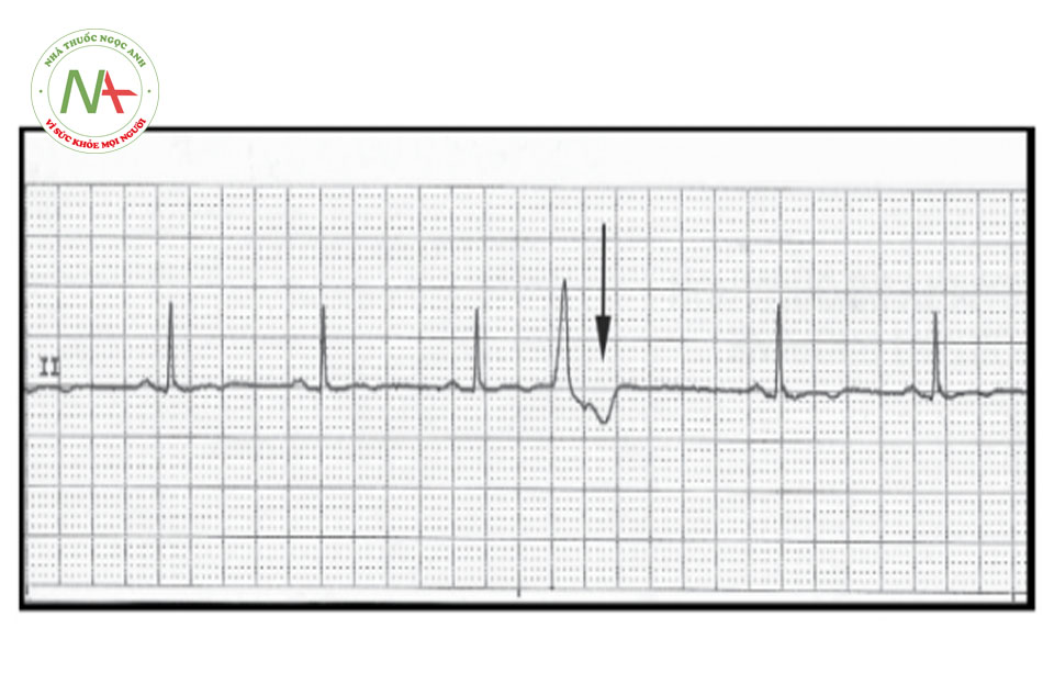 Hình 2. Sóng P dẫn ngược thất – nhĩ (mũi tên) ngay sau phức bộ QRS.