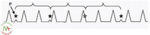 Hình 20. Phân ly nhĩ thất. Hoạt động điện của tâm nhĩ (sóng P) và tâm thất (Phức bộ QRS) hoàn toàn tách biệt và không có mối liên hệ nào với nhau.