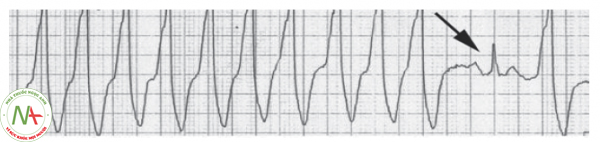 Hình 21. Cơn tim nhanh thất với phức bộ QRS giãn rộng và nhát bắt được thất (mũi tên) với phức bộ QRS thanh mảnh có sóng P đi trước.