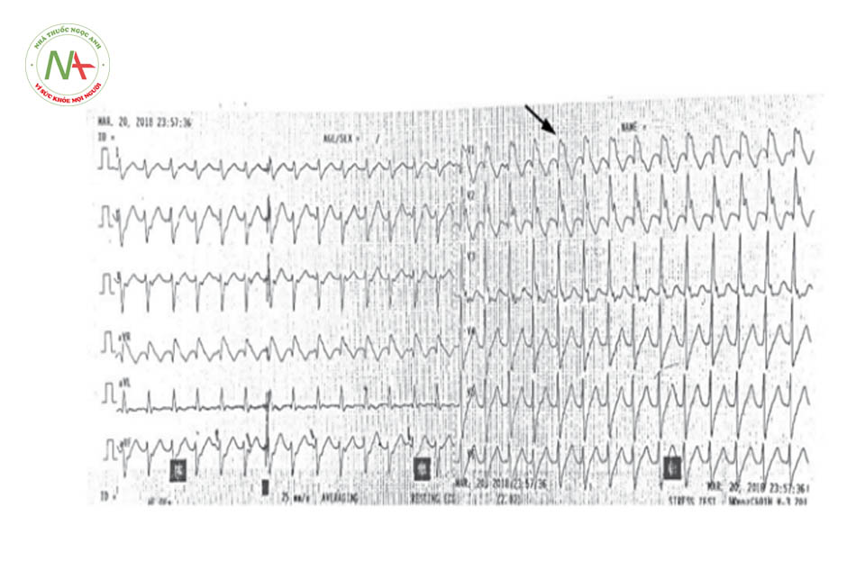 Hình 23. Cơn tim nhanh thất với phức bộ QRS giãn rộng và V1 có dạng block nhánh phải, gợi ý cơn tim nhanh thất khởi phát từ thất trái.