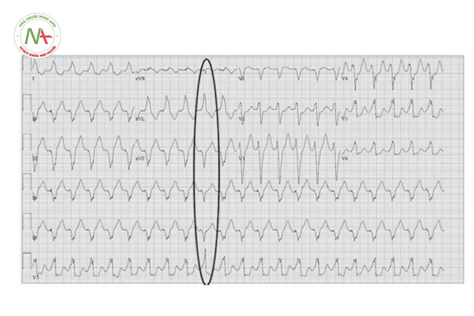 Hình 25. Cơn tim nhanh thất với nhát bóp hỗn hợp. Phức bộ QRS nhát bóp hỗn hợp biến đổi và khác với phức bộ QRS cơ sở của cơn tim nhanh thất.