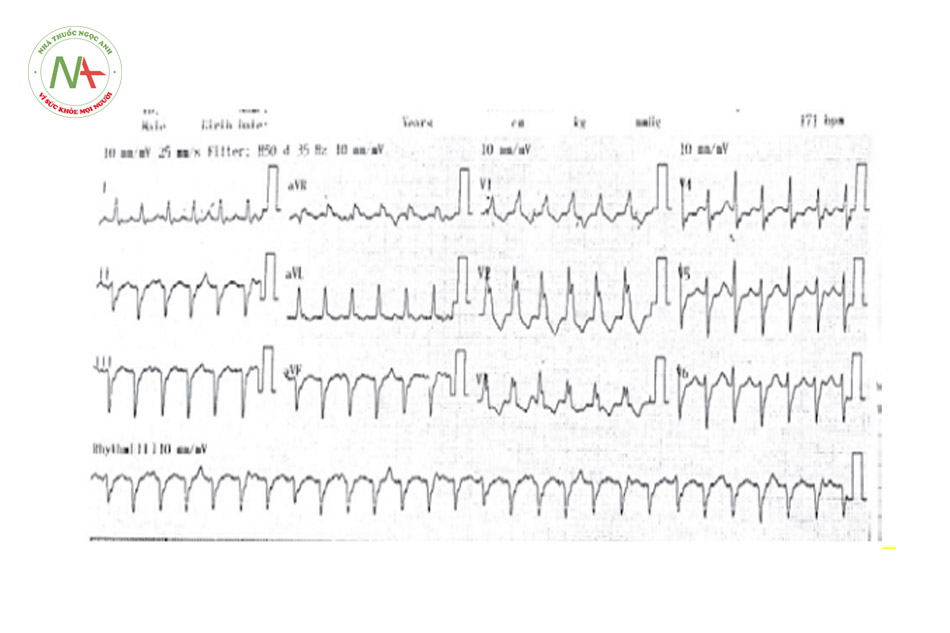 Hình 27. Cơn tim nhanh thất do vòng vào lại bó nhánh trái sau. Phức bộ QRS có dạng block nhánh phải kèm theo trục trái (- 90 độ).