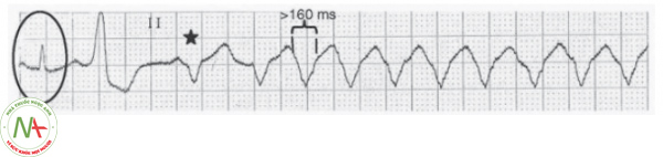 Hình 30. Cơn tim nhanh thất với phức bộ QRS giãn rộng bất thường. Phức bộ QRS trong cơn tim nhanh > 160 ms gợi ý cơn tim nhanh thất. Phức bộ QRS đầu tiên ngoài cơn tim nhanh thanh mảnh cho thấy không có biểu hiện tiền kích thích khi nhịp xoang. Phức bộ đánh dấu * là phức bộ nhát bóp hỗn hợp gợi ý cơn tim nhanh thất.