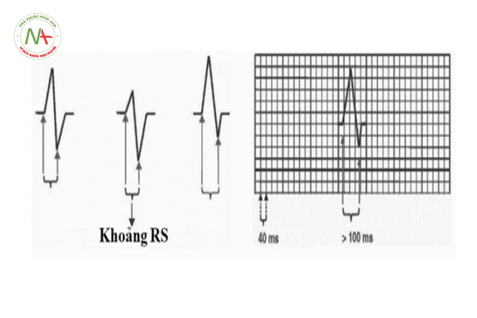 Hình 34. Cách đo khoảng RS. Tính từ khởi đầu sóng R đến đỉnh sóng S. Nếu RS > 100 ms thì khẳng định cơn tim nhanh thất.