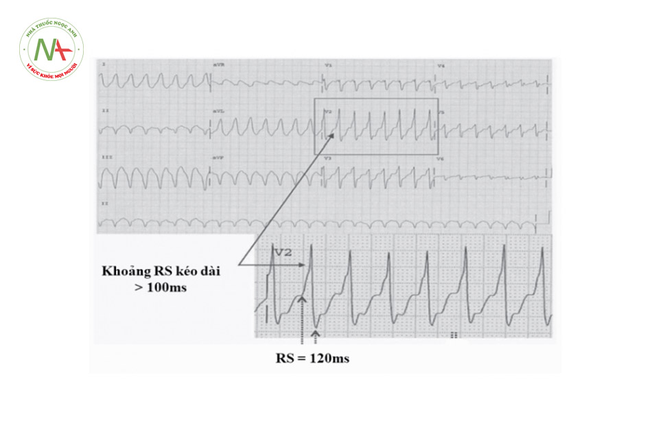 Hình 35. Cơn tim nhanh QRS giãn rộng với khoảng RS ở các chuyển đạo trước tim = 120 ms gợi ý cơn tim nhanh thất.