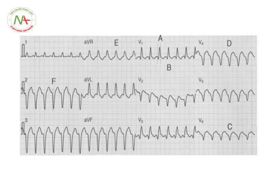 Hình 39. Cơn tim nhanh QRS giãn rộng dạng block nhánh phải. Tại V1 có dạng qR và V6 có dạng QS gợi ý cơn tim nhanh thất.