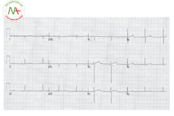 Hình 14. Block phân nhánh trái sau. Trục điện tim biểu hiện trục phải.