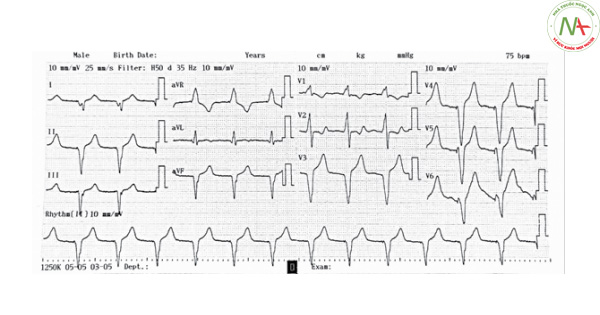 Hình 18. Điện tâm đồ máy tạo nhịp tái đồng bộ cơ tim. Spike tạo nhịp đi trước phức bộ QRS. Phức bộ tạo nhịp giãn rộng, có dạng block nhánh phải với QRS dương ở V1.