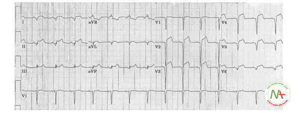 Hình 2. Điện tâm đồ trong bệnh cảnh viêm cơ tim. Đoạn ST chênh lên giống như trong Nhồi máu cơ tim cấp.