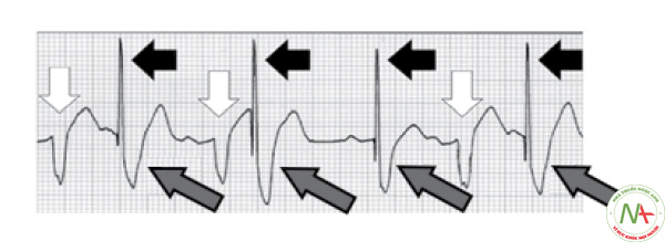 Hình 20. Hiện tượng nhận cảm dưới mức (Undersensing). Điện cực không nhận cảm được nhịp nội tại (mũi tên trắng), do đó vẫn đáp ứng hoạt động tạo nhịp với spike tạo nhịp (mũi tên đen) đi trước phức bộ QRS giãn rộng (mũi tên dài). Tại phức bộ thứ 4, spike tạo nhịp rơi vào sóng T của phức bộ nhịp nội tại đi trước tạo thành dạng ngoại tâm thu R/T, nguy cơ dẫn tới những rối loạn nhịp thất thứ phát như xoắn đỉnh hay rung thất.