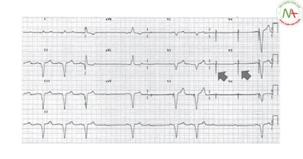 Hình 24. Máy tạo nhịp không dẫn. Những đoạn ngừng tim xen kẽ với những đoạn tạo nhịp của máy tạo nhịp. Tại những thời điểm các đoạn ngừng tim, vẫn quan sát thấy spike tạo nhịp (mũi tên) nhưng không tạo thành kích thích hiệu quả (mất phức bộ QRS đi phía sau).