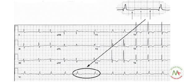 Hình 25. Cơn tim nhanh nhĩ. Tần số nhĩ khoảng 250 chu kỳ/phút. Xung nhịp nhĩ đến sớm và rơi vào thời kì trơ của nút nhĩ thất, do đó không dẫn được xuống thất, mất phức bộ QRS sau sóng P’.