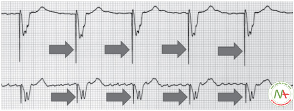 Hình 5. Spike tạo nhịp của máy tạo nhịp tim. Spike là một nét nhỏ, sắc nét (mũi tên) đi ngay phía trước phức bộ QRS trong trường hợp tạo nhịp tại tâm thất.