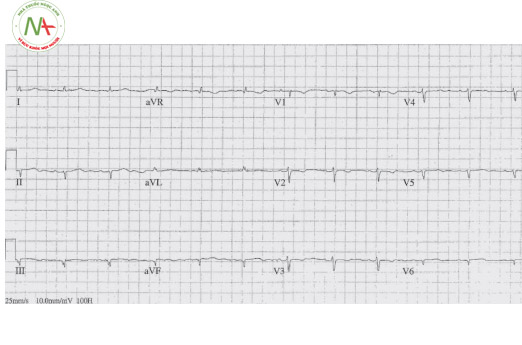Hình 8. Tràn dịch màng tim. Điện thế thấp. Biên độ phức bộ QRS ở các chuyển đạo ngoại biên < 5 mm.