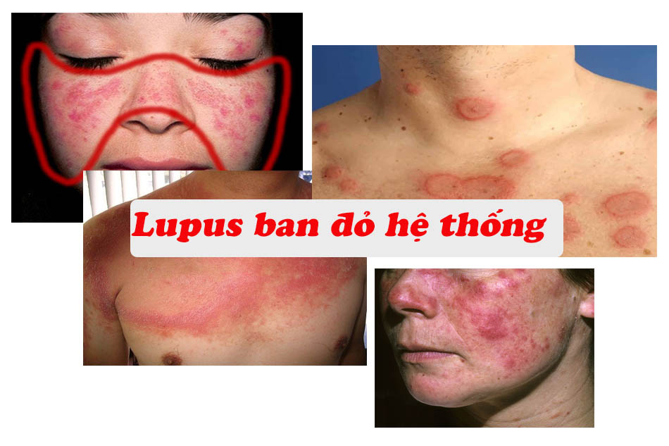 Lupus ban đỏ hệ thống
