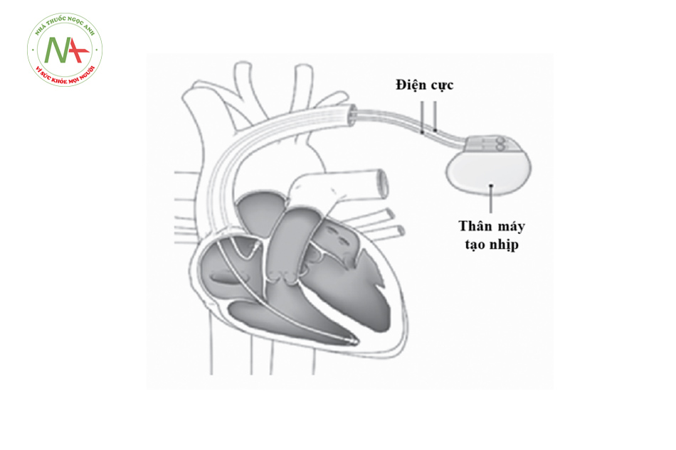 Hình 2. Máy tạo nhịp tim