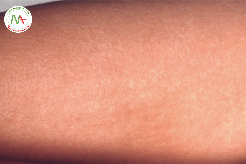 Hình 4: Phát ban của bệnh sốt tinh hồng nhiệt đầu tiên xuất hiện dưới dạng vệt màu đỏ nhỏ trên ngực và bụng, có thể lây lan khắp cơ thể; trông giống như cháy nắng, da có cảm giác giống như một miếng giấy nhám thô và phát ban kéo dài khoảng 2 đến 5 ngày
