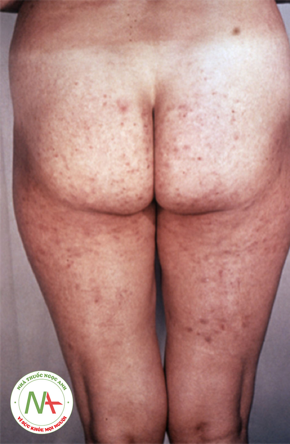 Hình 5: Bệnh nhân bị phát ban giống đào ban do bệnh giang mai, tương tự như biểu hiện của eczema do vi-rút, xuất hiện ở mông và chân trong giai đoạn thứ hai của bệnh