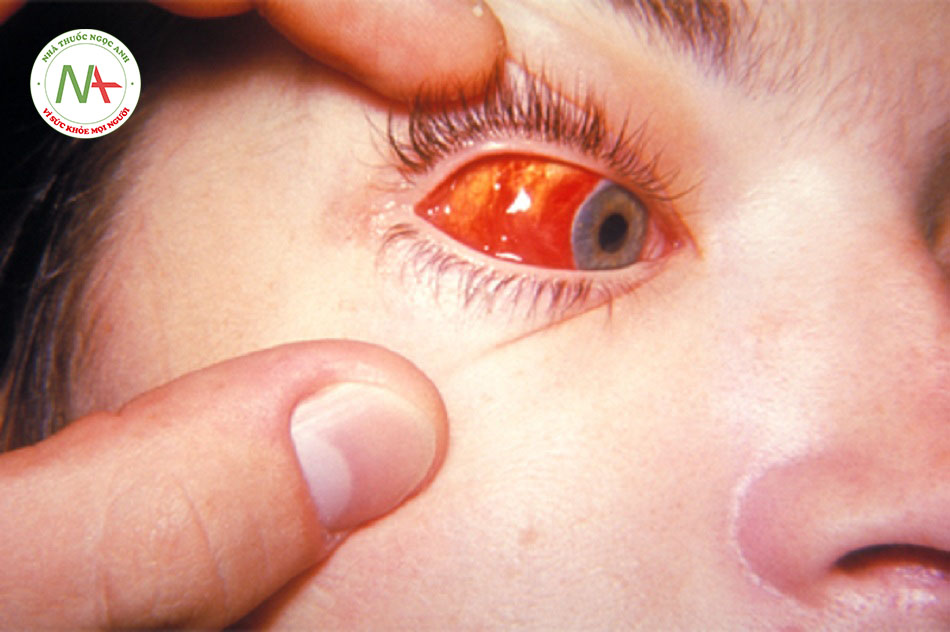 Hình 6: Xuất huyết kết mạc mắt phải ở bệnh nhân tăng bạch cầu đơn nhân do nhiễm trùng