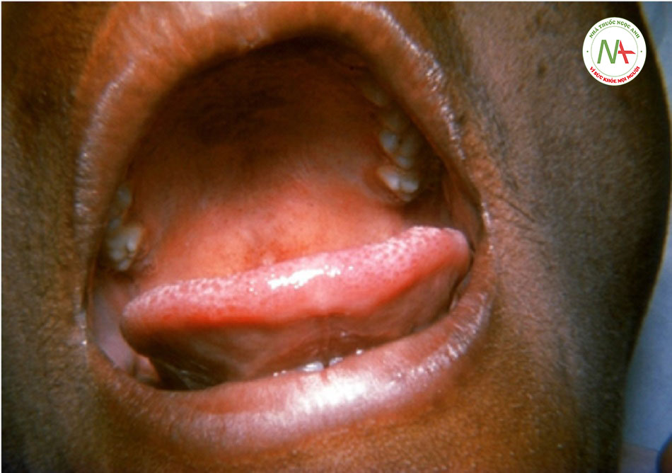 Hình 7: Lưỡi và vòm miệng của bệnh nhân tăng bạch cầu đơn nhân do nhiễm trùng