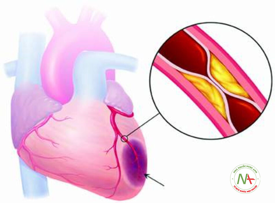 Nhồi máu cơ tim không ST chênh lên: Nguyên nhân, chẩn đoán và hướng dẫn điều trị theo BMJ