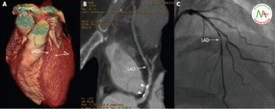 Hình 4: Ảnh chụp CT mạch máu 64 dãy của bệnh nhân bị đau thắt ngực ổn định cho thấy sự tái tạo 3D (A), hình ảnh tái định dạng cong (B) và xác nhận tổn thương mức độ nặng trên ảnh chụp mạch máu thông thường (C). Đầu mũi tên cho thấy mảng xơ vữa bị vôi hóa. Dx= chẩn đoán