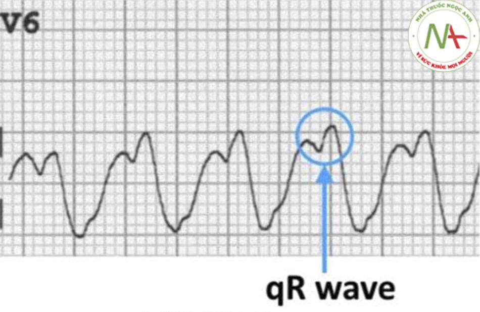 Dạng qR ở V6 (sóng q nhỏ kèm theo sóng R lớn)