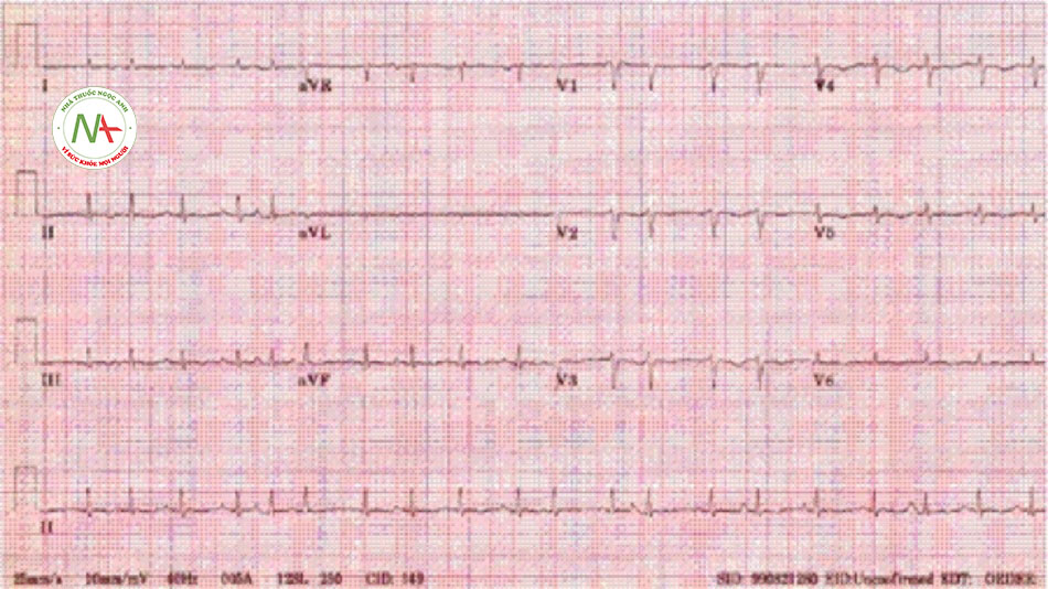 Hình 4: Nhịp tim nhanh nhĩ đa ổ