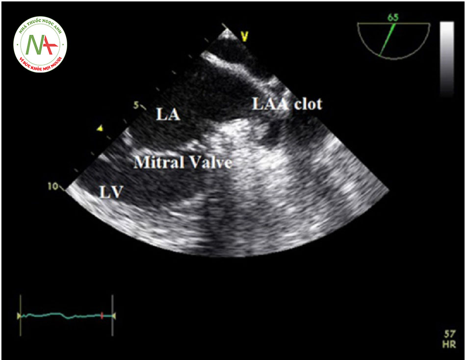 Hình 5: Siêu âm tim qua thực quản cho thấy cục máu đông bám vào tiểu nhĩ trái. LA=nhĩ trái; LAA=tiểu nhĩ trái; LV=thất trái.