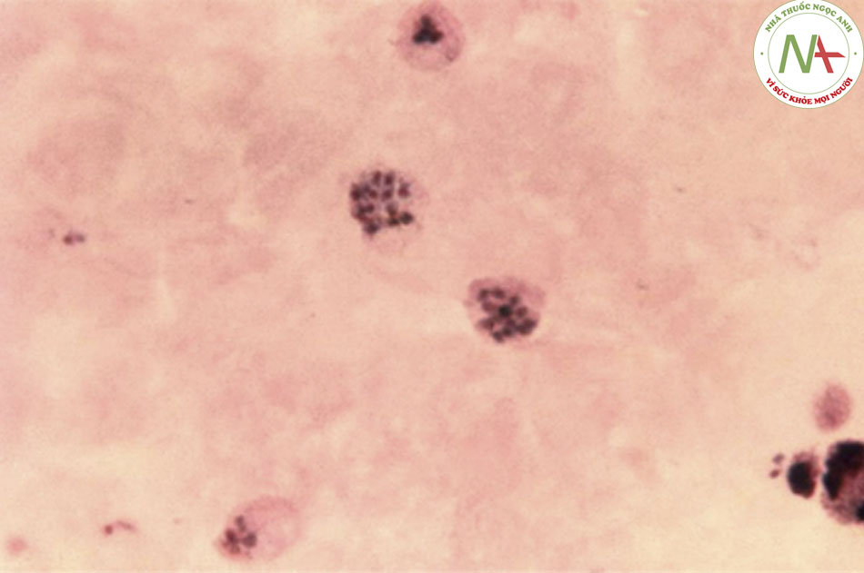 Hình 5: Soi kính hiển vi nhuộm Giemsa màng dày cho thấy hai thể phân liệt Plasmodium trưởng thành, mỗi thể đều chứa thể hoa thị Thư hiện Hình ảnh Trung tâm Kiểm soát và Phòng ngừa Dịch bênh; đã được phép sử dụng