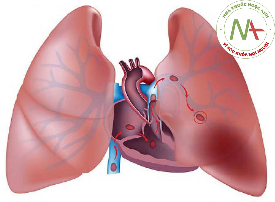 Tắc mạch phổi: cách phòng ngừa, chẩn đoán và điều trị theo BMJ