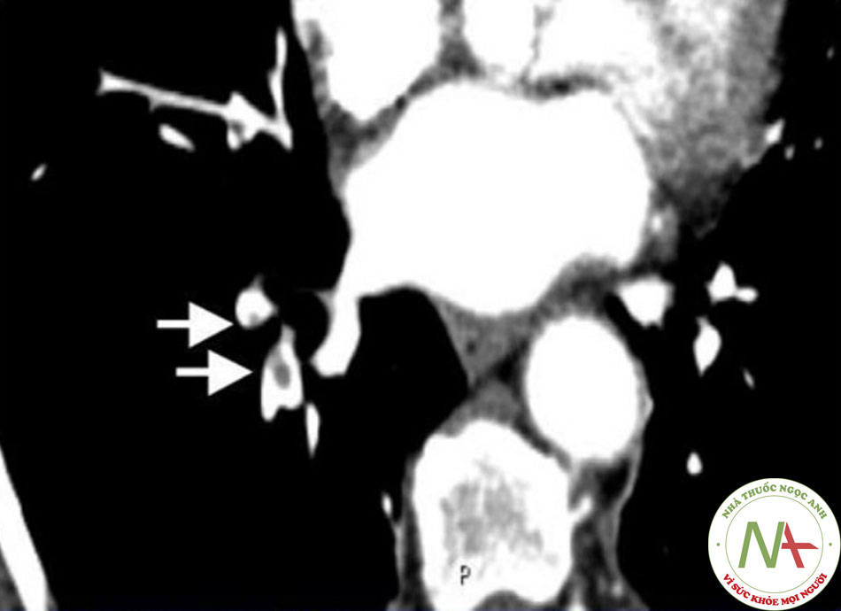 Hình 3: CTPA có cản quang cho thấy tắc nghẽn động mạch phổi nhánh hạ phân thùy bên phải (xem mũi tên) Trích từ thông tin thu thập Seth W. Clemens; đã được phép sử dụng