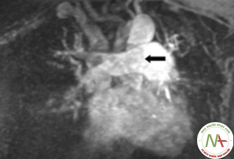 Hình 4: Gd-MRA cho thấy thuyên tắc ở động mạch chính phổi phải (xem mũi tên) Trích từ thông tin thu thập Seth W. Clemens; đã được phép sử dụng