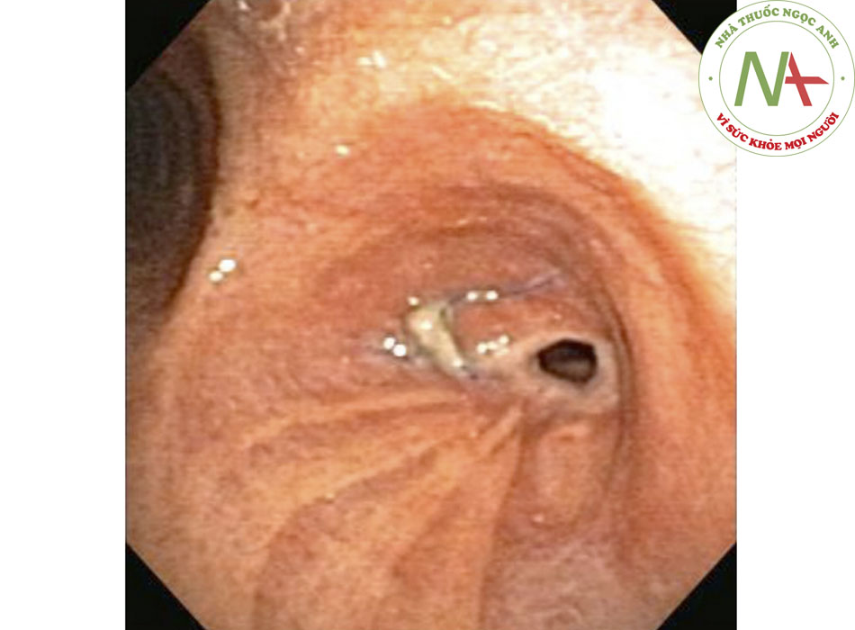 Hình 4: Hẹp phế quản đoạn nối sau khi ghép phổi Trích từ tư liệu của Jose Fernando Santacruz MD, FCCP, DAABIP và Erik Folch MD, MSc; đã được phép sử dụng