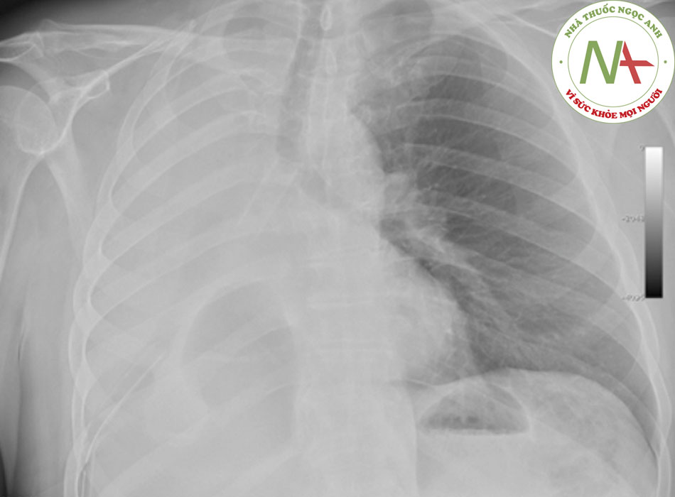 Hình 5: Chụp x quang ngực cho thấy stent trong lòng phế quản chính bị tắc nghẽn bởi dịch nhầy Trích từ tư liệu của Jose Fernando Santacruz MD, FCCP, DAABIP và Erik Folch MD, MSc; đã được phép sử dụng