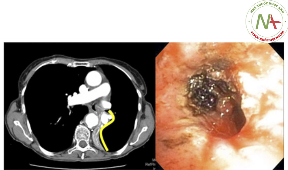 Hình 7: Dáu hiệu S vàng hoặc S đảo ngược trên ảnh chụp CT ngực (hình trái) theo đường màu vàng. Soi phế quản bằng ống mềm (hình bên phải) cho thấy tổn thương tắc nghẽn trung tâm tại phế quản chính bên trái. Trích từ tư liệu của Jose Fernando Santacruz MD, FCCP, DAABIP và Erik Folch MD, MSc; đã được phép sử dụng