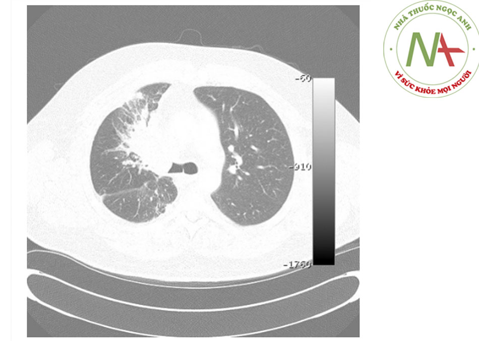 Hình 8: Tắc nghẽn nội phế quản ác tính trên ảnh chụp CT ngực đa đầu thu: cửa sổ phổi cho thấy tắc nghẽn ác tính phế quản chính phải Trích từ tư liệu của Jose Fernando Santacruz MD, FCCP, DAABIP và Erik Folch MD, MSc; đã được phép sử dụng