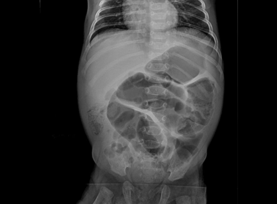 Hình 2: Chụp X-quang bụng cho thấy tắc ruột hoàn toàn. Từ thông tin thu thập của Tiến sĩ David J. Hackam