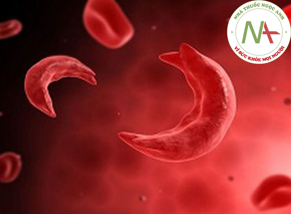 Thiếu máu hồng cầu lưỡi liềm theo phân tích của BMJ