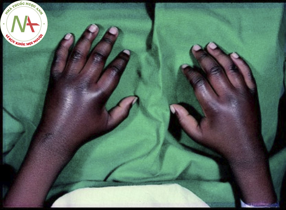 Hình 2: Hội chứng tay-chân ở bệnh nhân từ 14 tháng tuổi với bệnh hồng cầu lưỡi liềm đồng hợp tử Từ: Davies SC, Oni L. BMJ. 1997;315:656-660