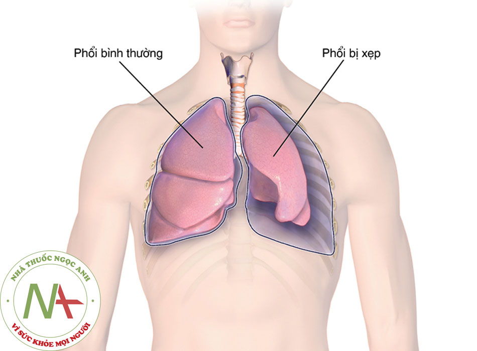 Tràn khí màng phổi theo BMJ