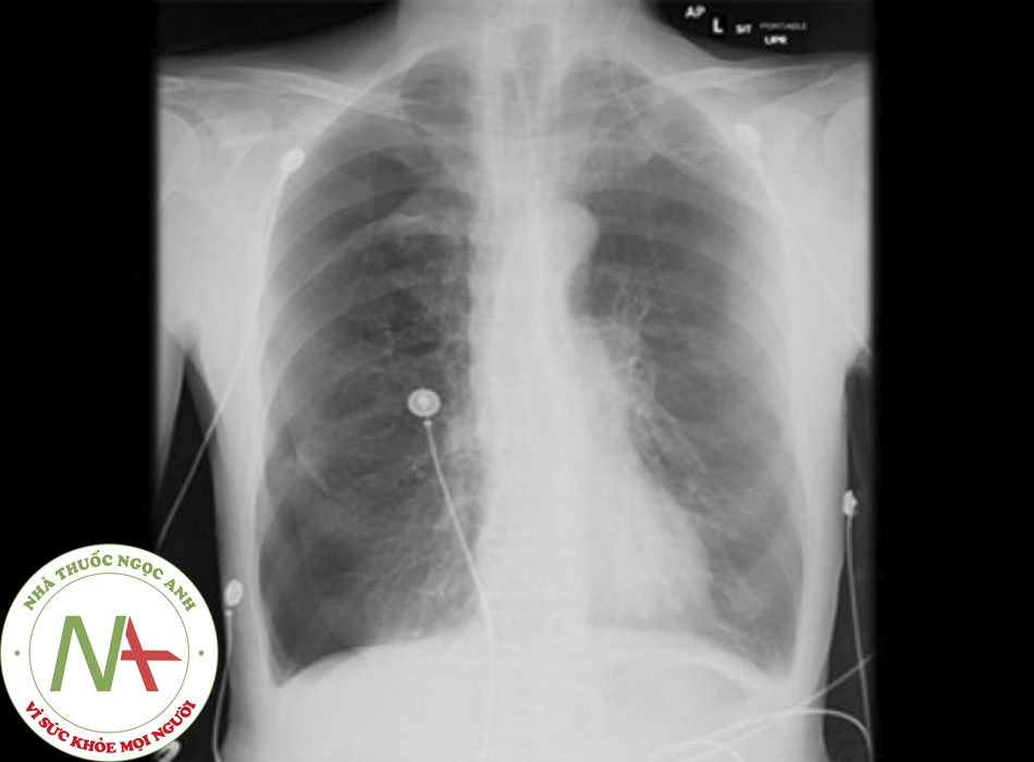 Hình 1: Xquang ngực thẳng có hình ảnh tràn khí màng phổi phải Tư liệu của Tiến sĩ Ryland P. Byrd